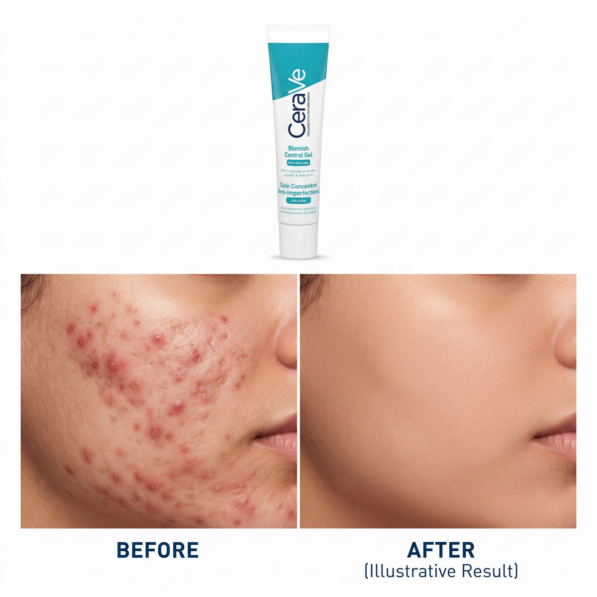 CeraVe Blemish Control Gel Moisturiser – AHA BHA Acne Treatment with Salicylic Acid