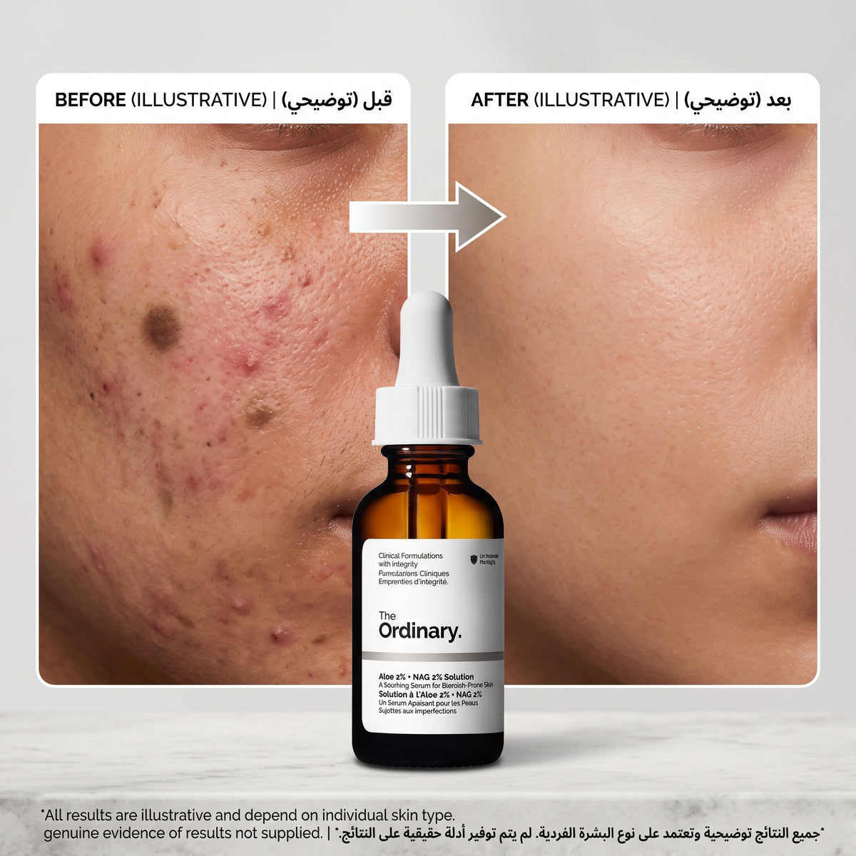 The Ordinary Salicylic Acid 2% Solution 30ml – Leave-On BHA for Blackheads & Congested Pores