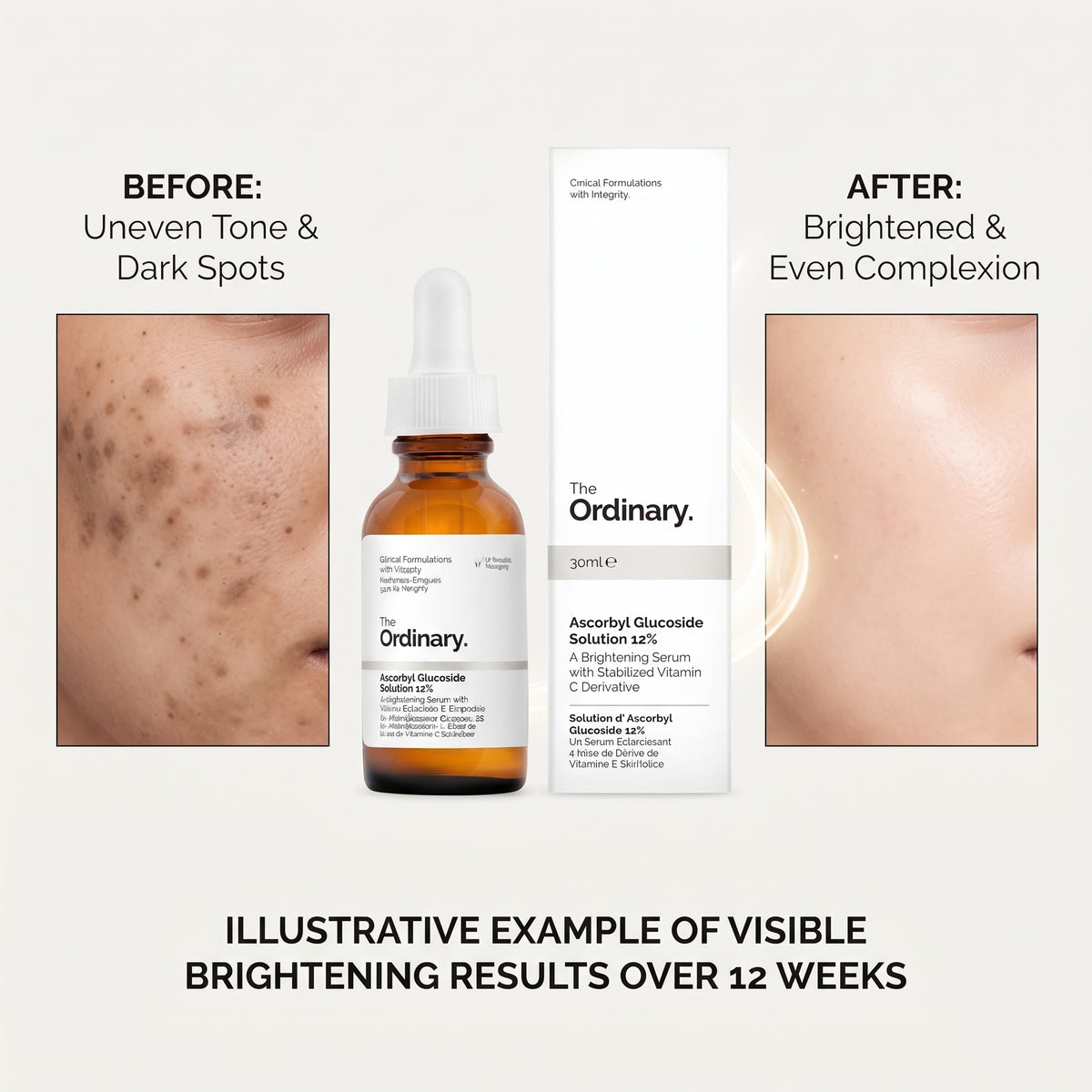 The Ordinary Ascorbyl Glucoside Solution 12% 30ml – Gentle Vitamin C Serum