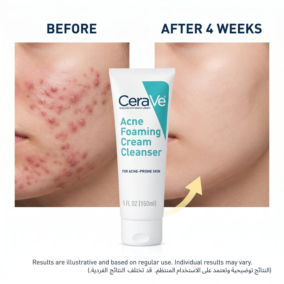 CeraVe Acne Foaming Cream Cleanser 150ml – 4% Benzoyl Peroxide Face Wash for Acne